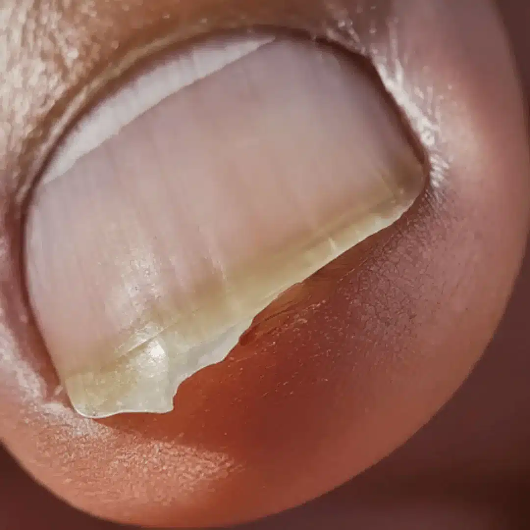 Ongles de pieds pâles et cassants