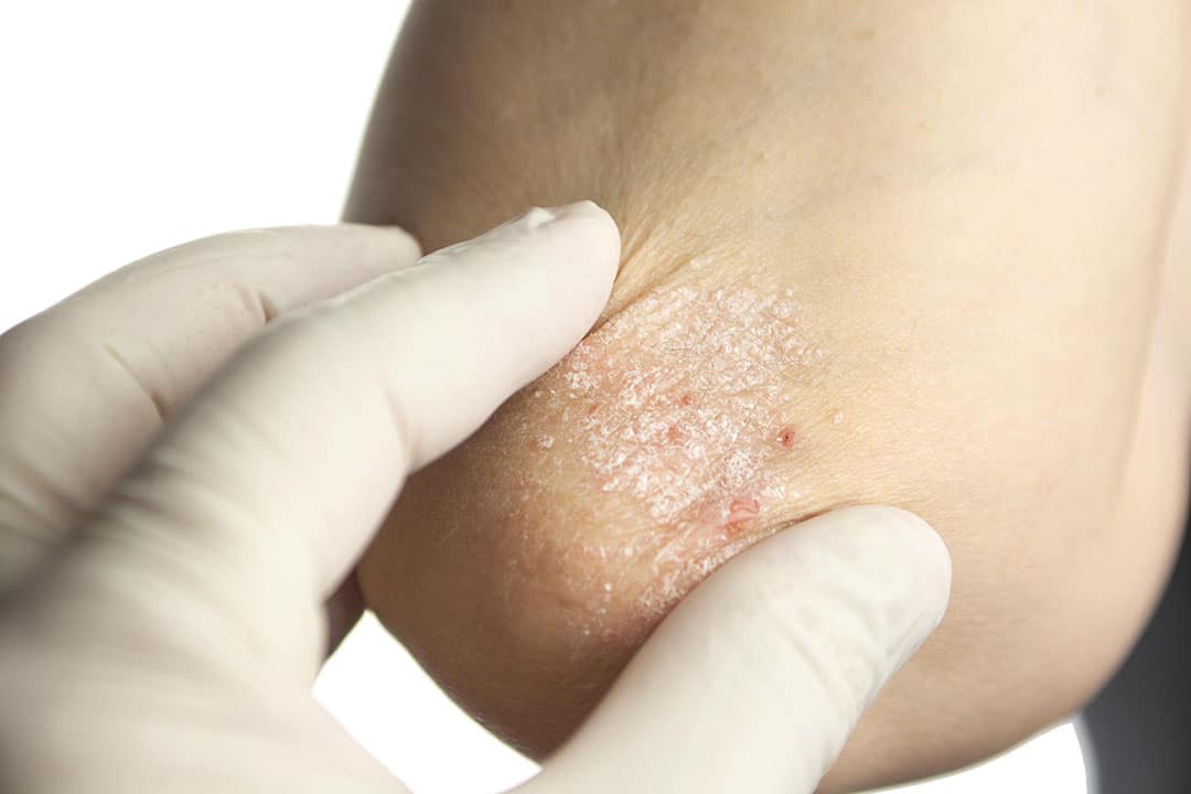 Psoriasis sur les coudes