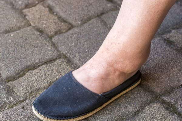 Pieds avec cicatrices