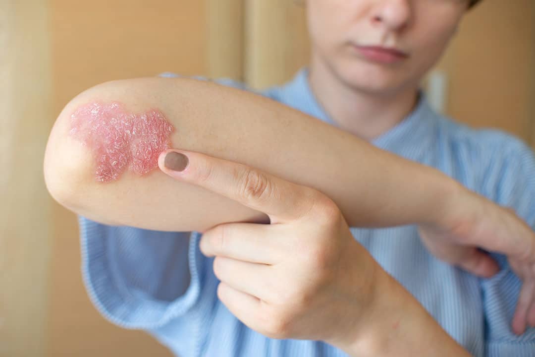 Eczéma sur le coude