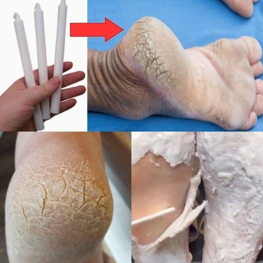Illustration d'un soin pour les pieds à base de cire