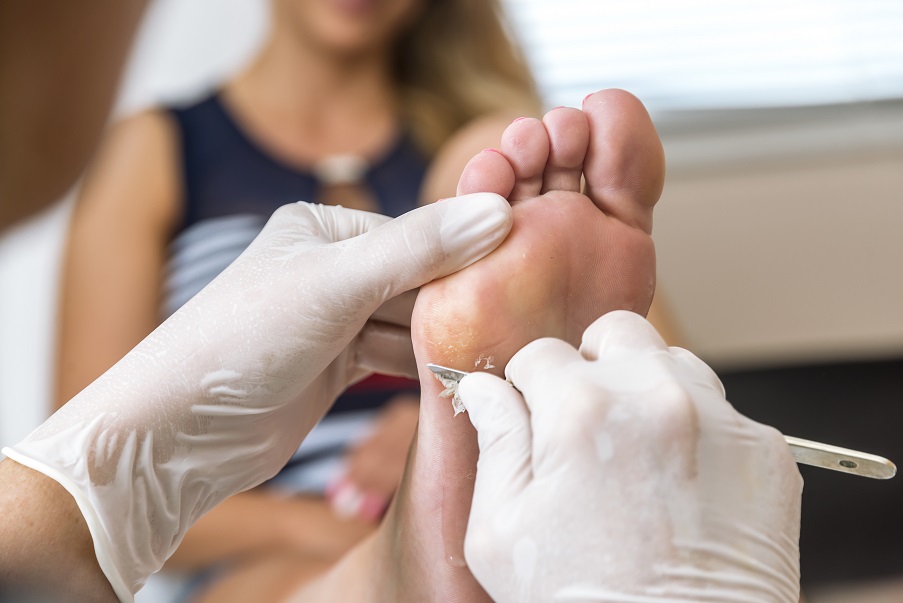 Exemple de verrue nécessitant un avis dermatologique