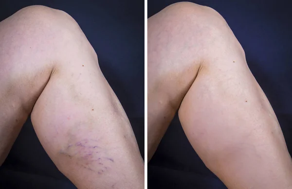 Illustration médicale de varices sur une jambe