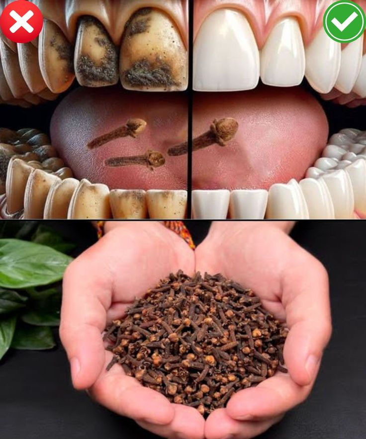 Clous de girofle, un rem&egrave;de naturel pour les dents et les gencives