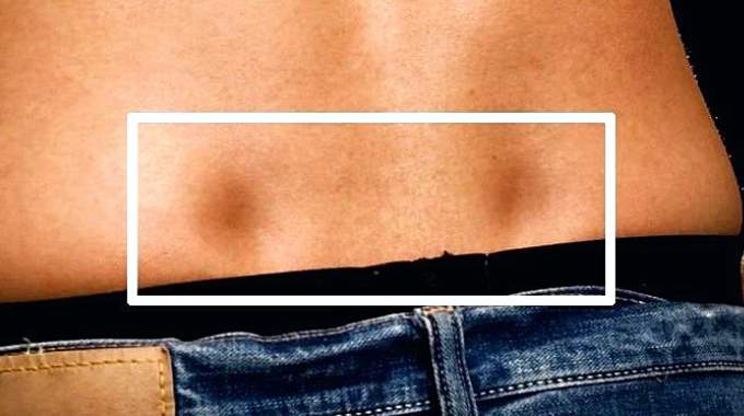 Repr&eacute;sentation artistique historique des fossettes lombaires